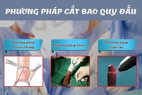 Phương pháp cắt bao quy đầu phổ biến hiện nay