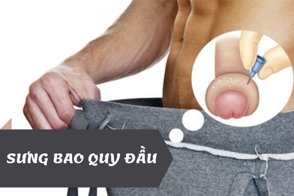 Sưng bao quy đầu – Cảnh báo nhiều bệnh lý nghiêm trọng cần lưu ý