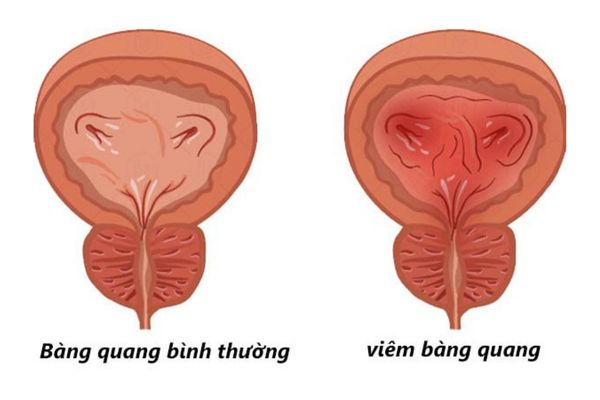 Viêm bàng quang là bệnh lý khá phổ biến ở nam giới