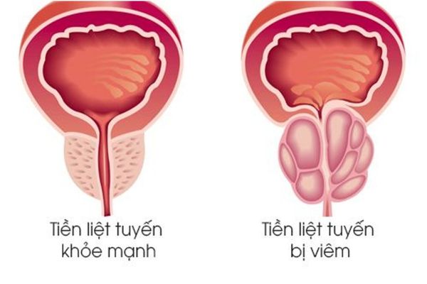 Viêm tuyến tiền liệt là bệnh lý phổ biến ở nam giới