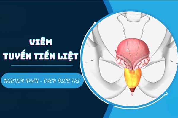 Viêm tuyến tiền liệt là bệnh gì? Nguyên nhân và cách điều trị hiệu quả