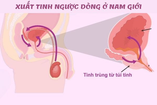 Xuất tinh ngược là bệnh lý thường gặp ở các cánh mày râu