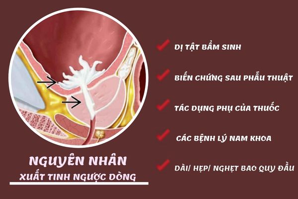 Nguyên nhân xuất tinh ngược dòng ở nam giới