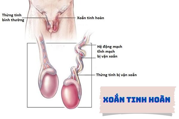 Xoắn tinh hoàn là bệnh lý nguy hiểm cần đặc biệt đề phòng