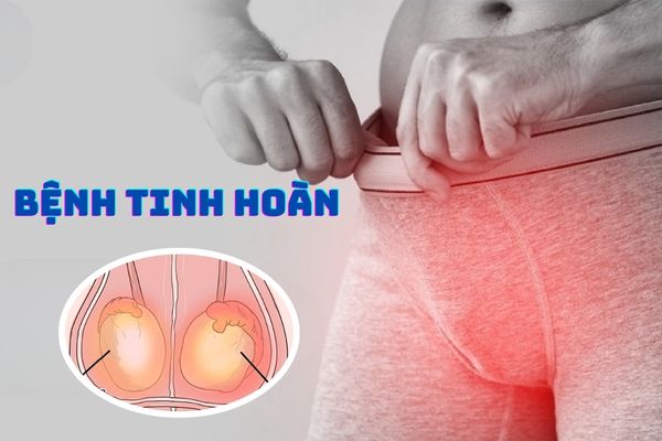 Tìm hiểu một số bệnh tinh hoàn phổ biến ở nam giới