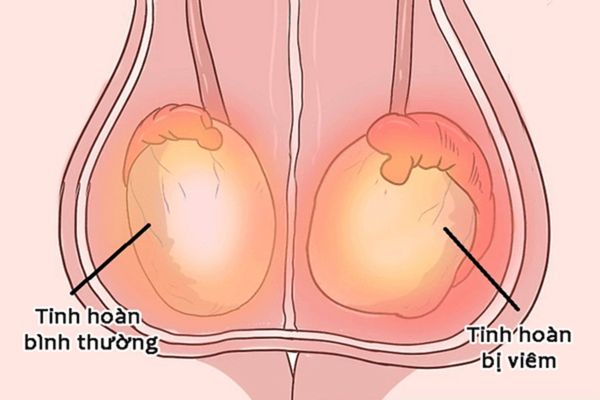 Viêm tinh hoàn là bệnh lý phổ biến ở nam giới