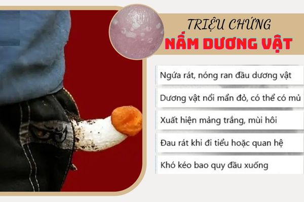 Triệu chứng nấm dương vật thường gặp ở nam giới