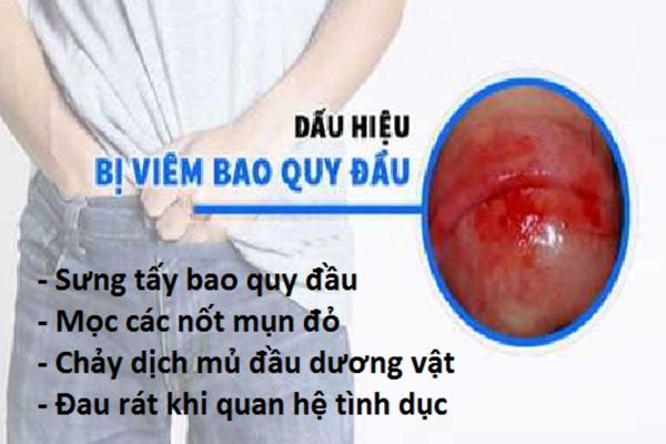 Viêm nhiễm bao quy đầu gây nên tình trạng ngứa vùng kín nam