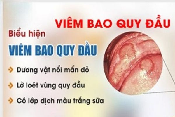 Viêm bao quy đầu khiến dương vật bị lở loét