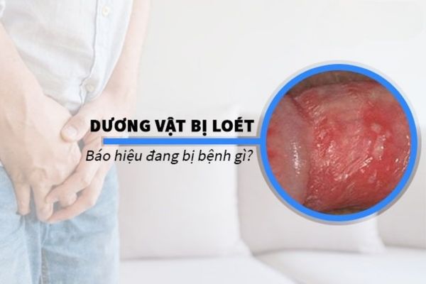 Dương vật bị lở loét – Dấu hiệu cảnh báo bệnh lý nguy hiểm