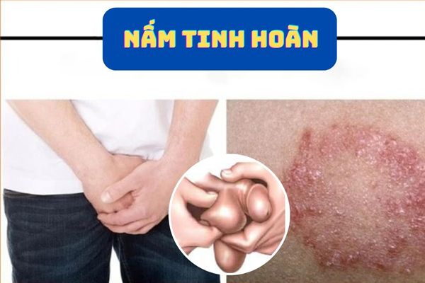 Nấm tinh hoàn là bệnh lý phổ biến gây ngứa rát, khó chịu ở tinh hoàn