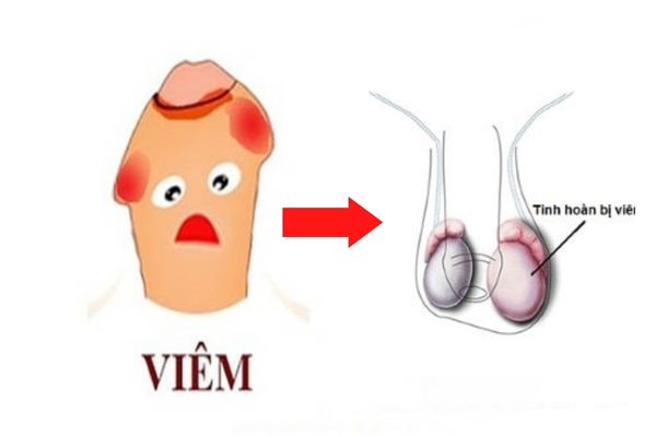 Viêm tinh hoàn có thể do viêm bao quy đầu gây ra