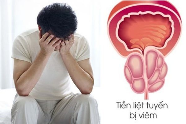 Viêm tuyến tiền liệt có thể gây suy giảm chức năng tinh hoàn