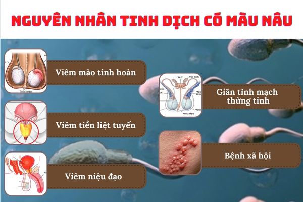 Tinh dịch có màu nâu cảnh báo nhiều bệnh lý nguy hiểm