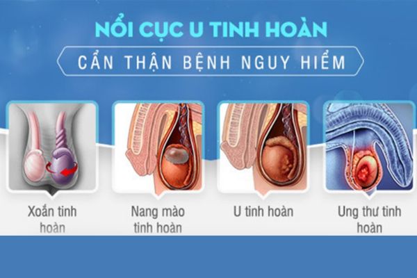 Tinh hoàn nổi cục cảnh báo nhiều bệnh lý nguy hiểm