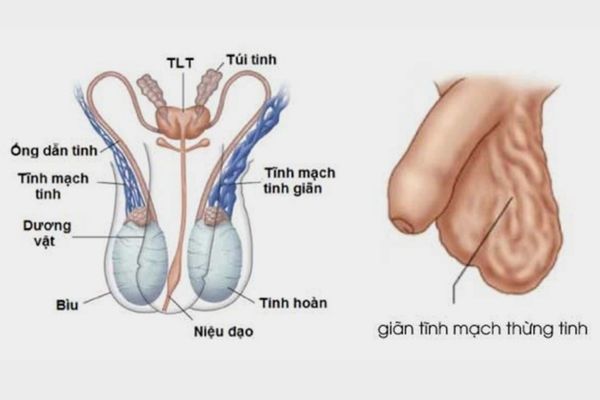 Giãn tĩnh mạch thừng tinh làm xuất hiện các cục hạch bất thường