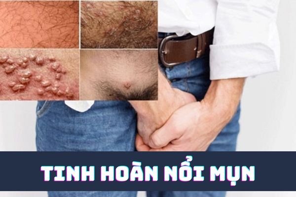 Tinh hoàn nổi mụn bất thường là dấu hiệu của bệnh gì?