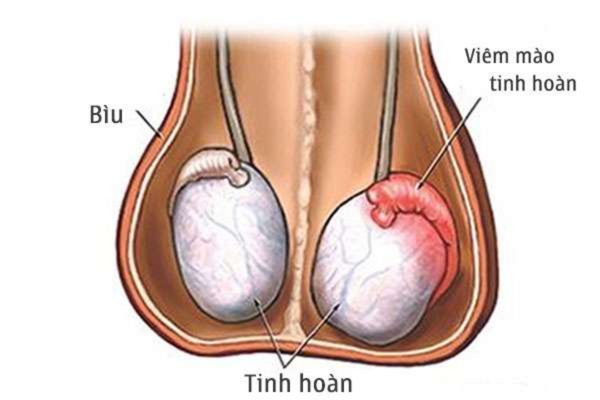 Viêm mào tinh hoàn là bệnh lý thường gặp ở nam giới