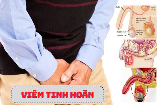 Biến chứng nguy hiểm của viêm tinh hoàn cần lưu ý