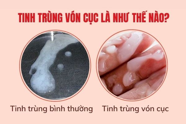 Tinh trùng vón cục có những biểu hiện rất dễ nhận biết