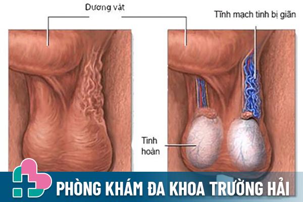 Giãn Tĩnh Mạch Thừng Tinh Là Gì? Cách Điều Trị Cho Nam Giới